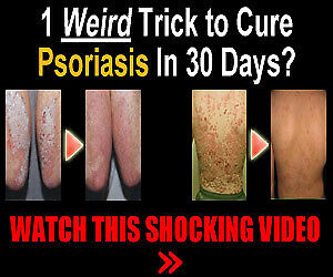 cure psoriasis in 30 days