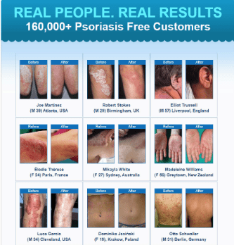 real people real psoriasis results