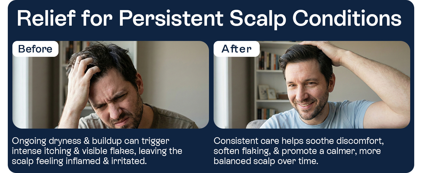 Psoriasis Scalp Spray
