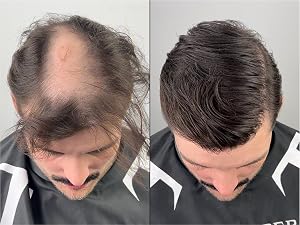 Hair Building Fiber Before After 5
