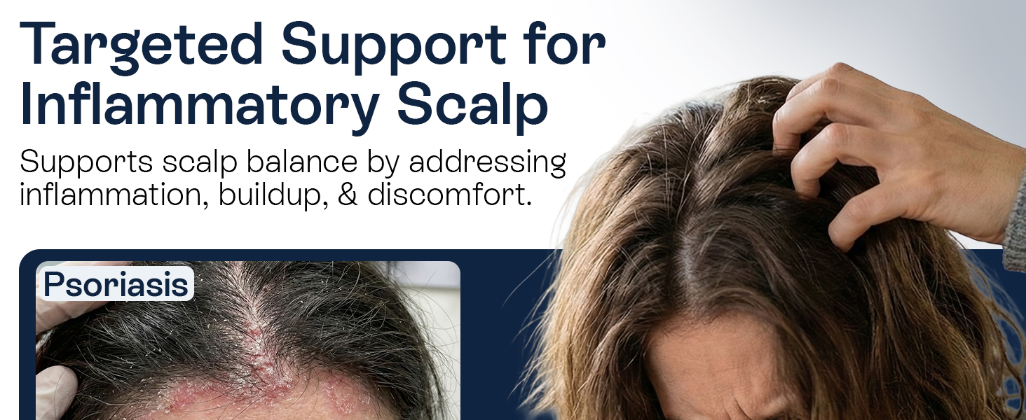 Psoriasis Scalp Spray