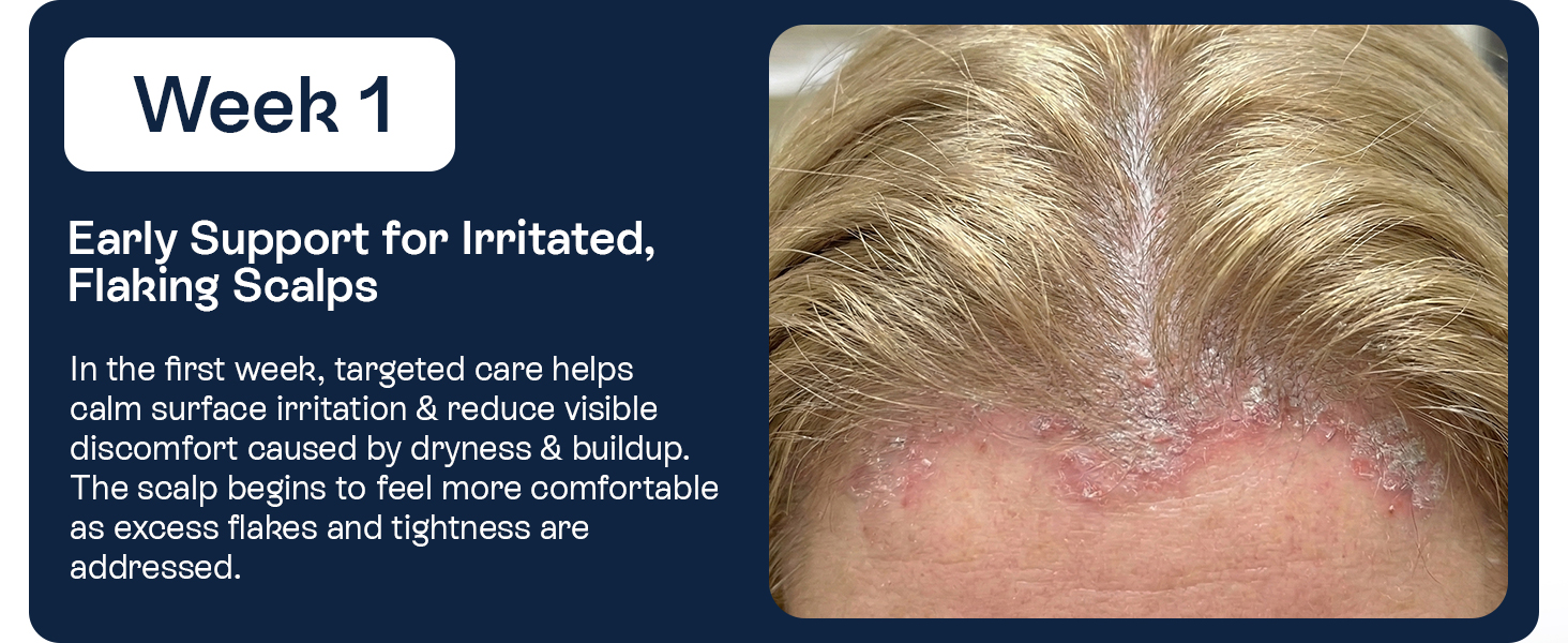Psoriasis Scalp Spray